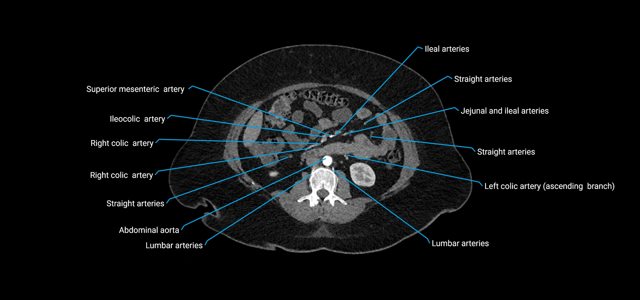 CTA abdomen axial cross sectional anatomy labelled image_95 (2).webp